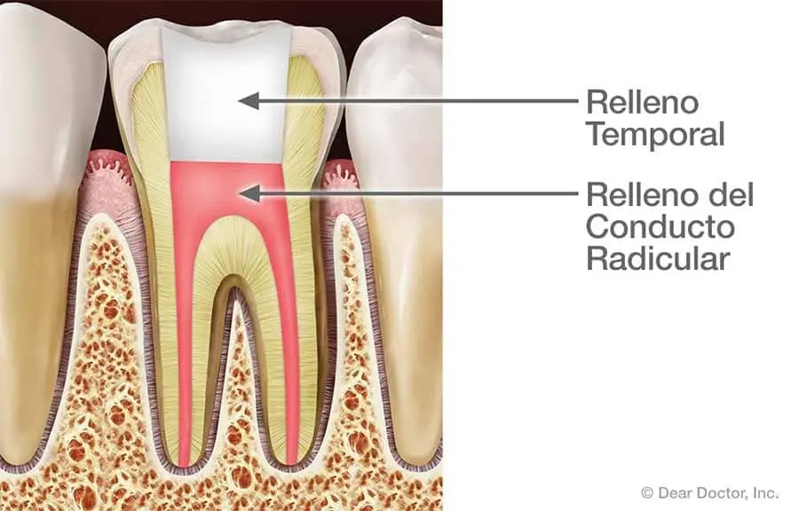 conducto dentista - Cuánto dura un conducto en un diente