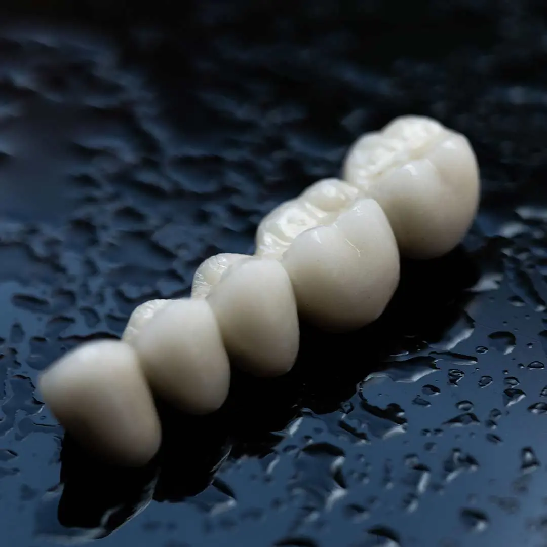 Puente dental para dientes delanteros: tipos y duración