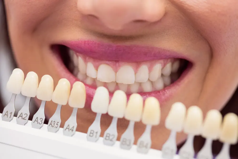 brillos en los dientes - Cuánto duran los brillos en los dientes