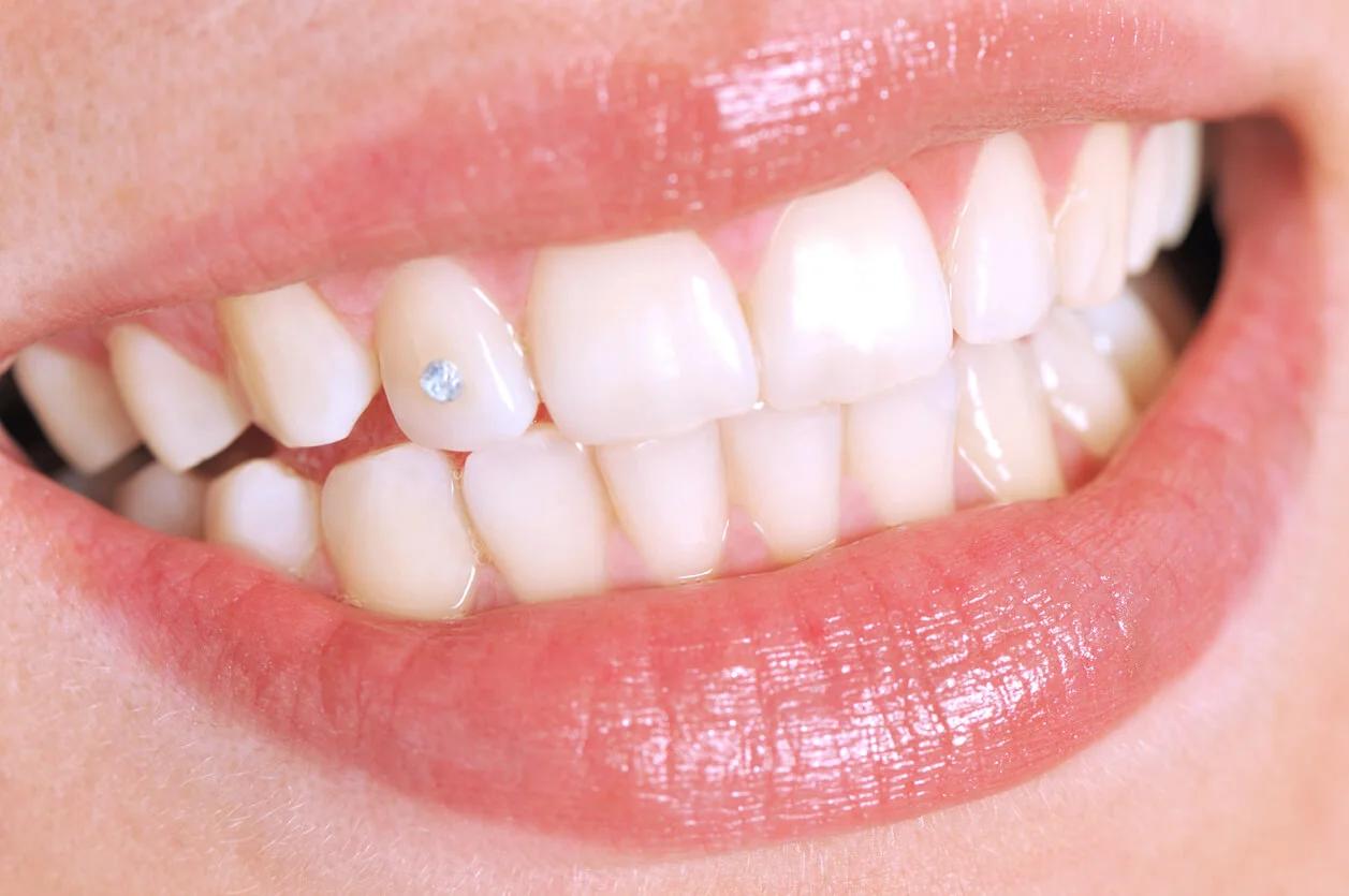 diamantes en los dientes - Cuánto duran los diamantes en los dientes