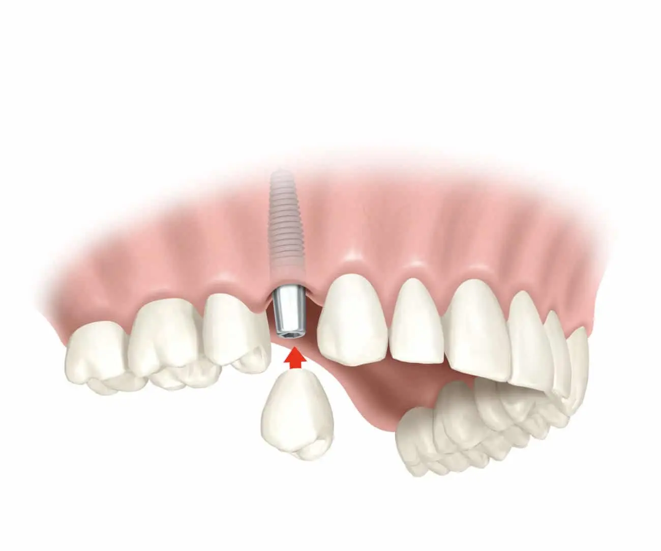 implantes de dientes precios - Cuánto puede costar una dentadura postiza fija