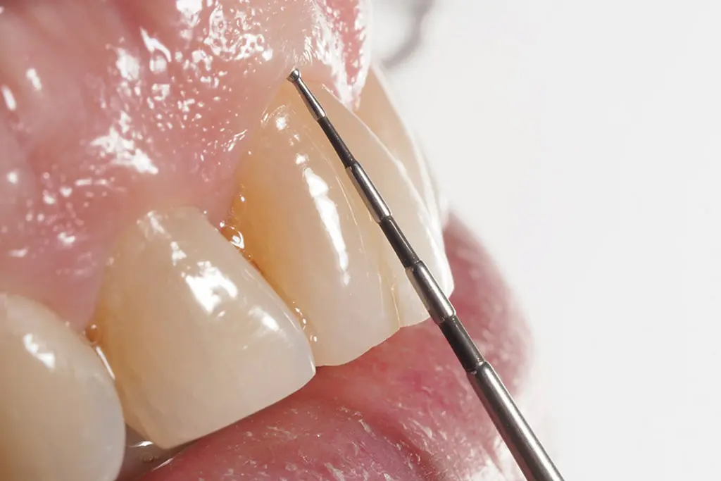 la encia se separa del diente - Cuánto tarda en pegarse la encía al diente