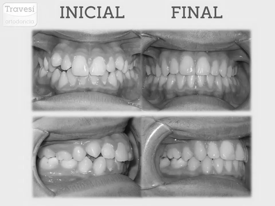 invisalign dientes - Cuánto tardan en alinearse los dientes con Invisalign