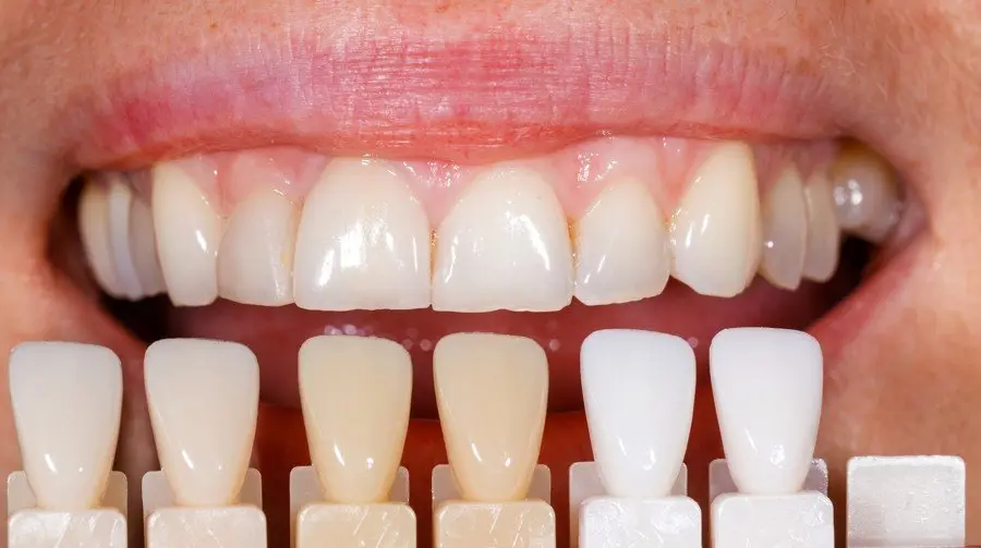 los dientes amarillos pueden volver a ser blancos - Cuánto tardan en blanquearse los dientes amarillos