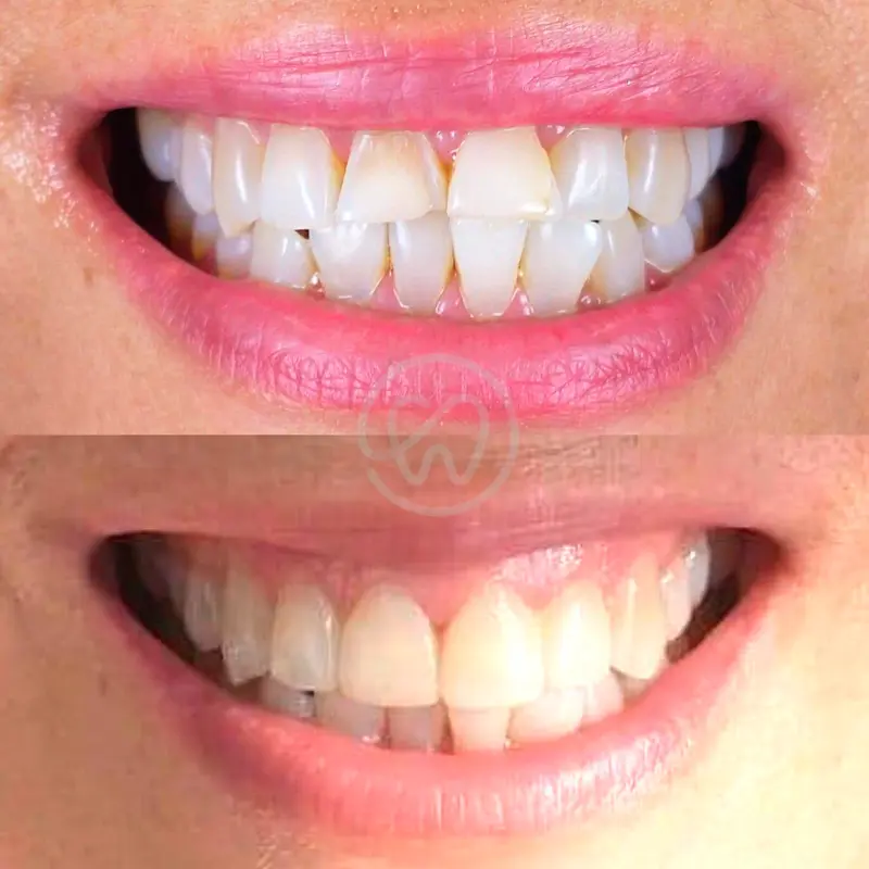 relleno de resina en dientes - Cuánto tiempo dura una restauracion con resina