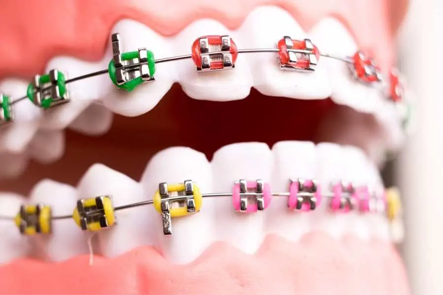 gomas ortodoncia - Cuánto tiempo hay que ponerse las gomas de los brackets