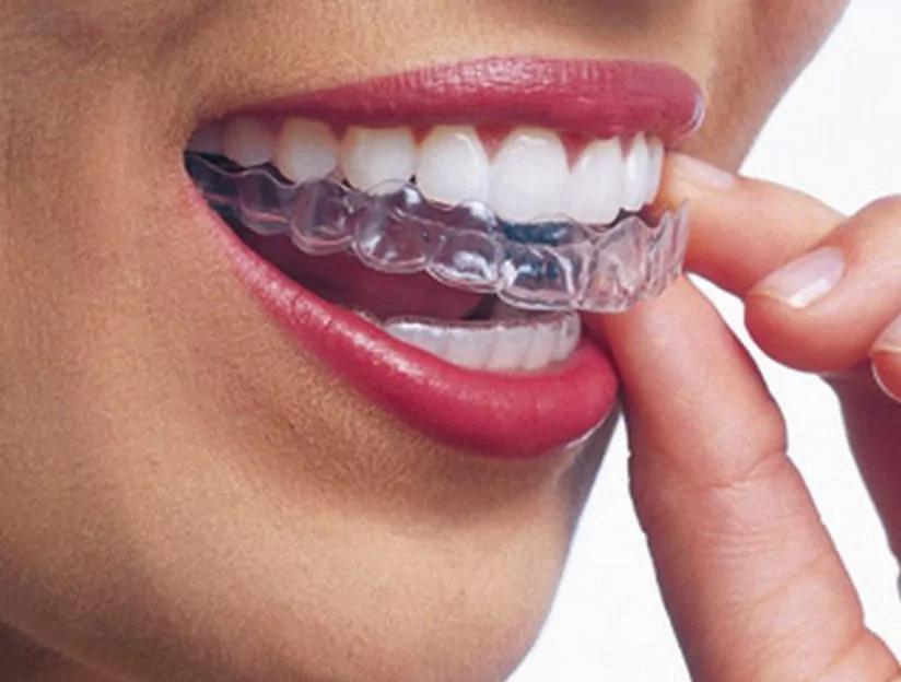 retenedores post ortodoncia - Cuánto tiempo se deben usar los retenedores después de la ortodoncia