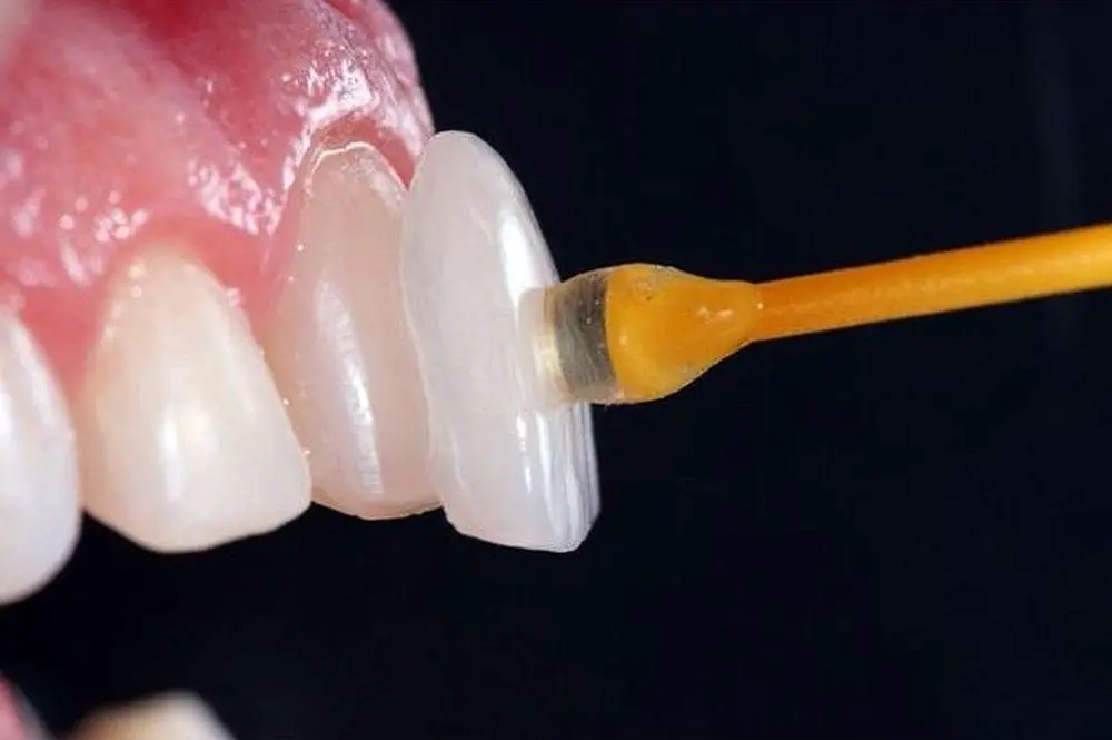 cómo se colocan las carillas en los dientes - Cuánto tiempo se tarda en poner una carilla dental