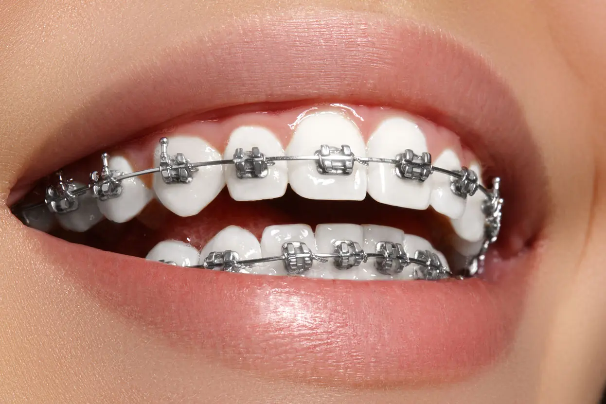 brackets para enderezar los dientes - Cuánto tiempo tardan en enderezar los dientes con brackets