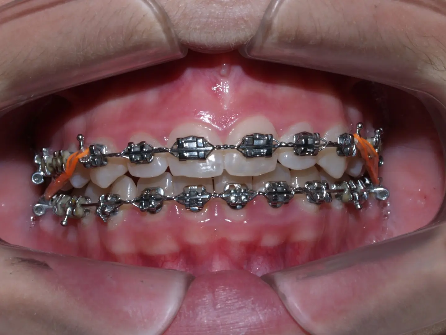 brackets dientes de abajo - Cuántos brackets se colocan en los dientes de abajo