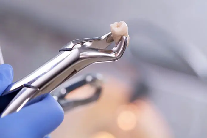 extraccion de dientes - Cuántos dientes se pueden extraer a la vez