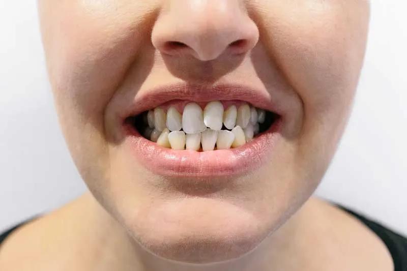 troneras dientes - Por qué hay huecos entre los dientes