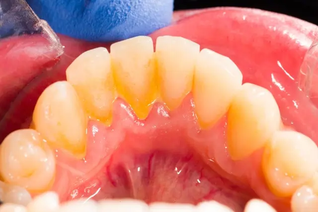 placa en los dientes - Por qué sale placa en los dientes