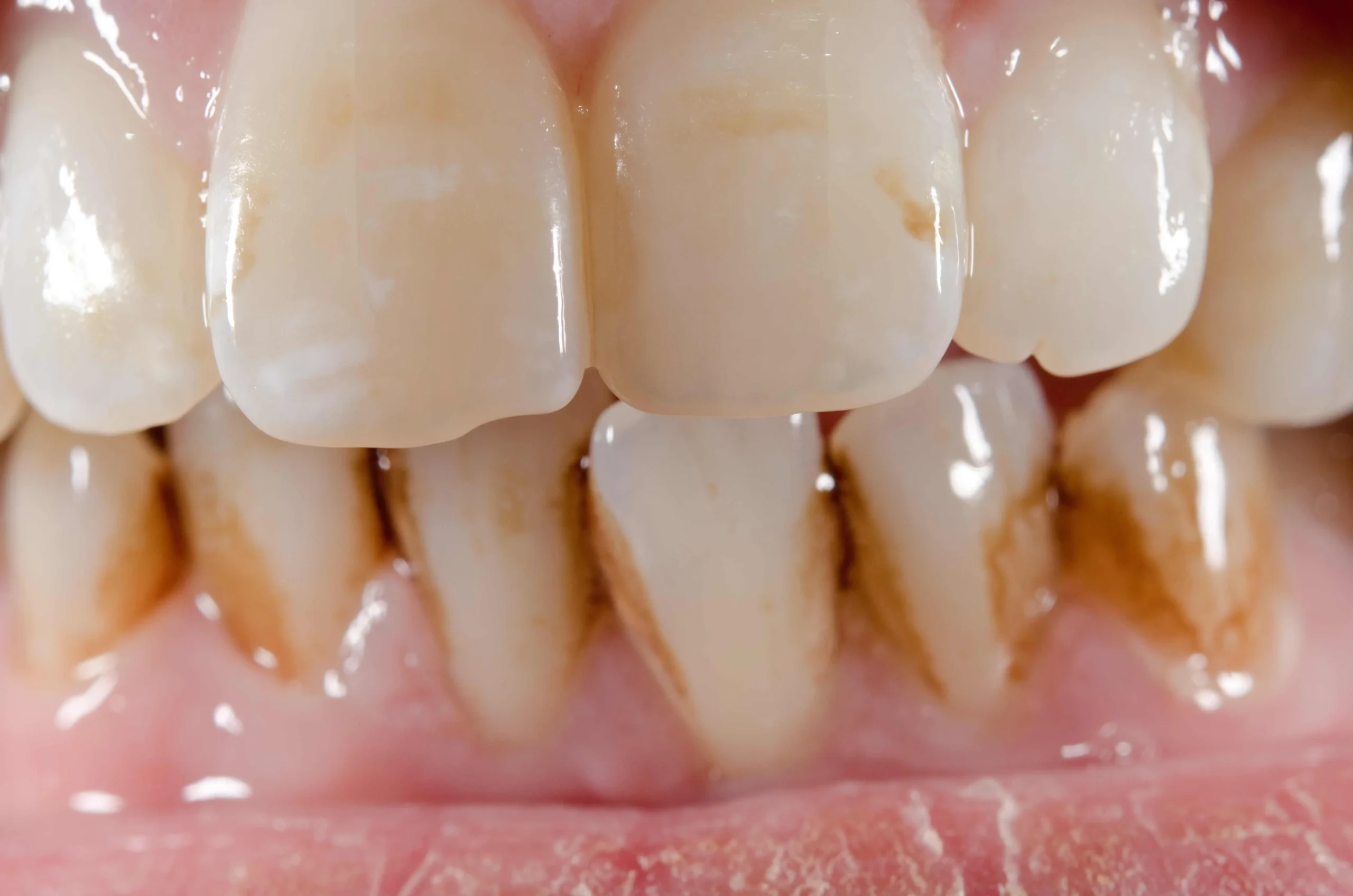 por que se manchan los dientes - Por qué salen manchas cafés en los dientes