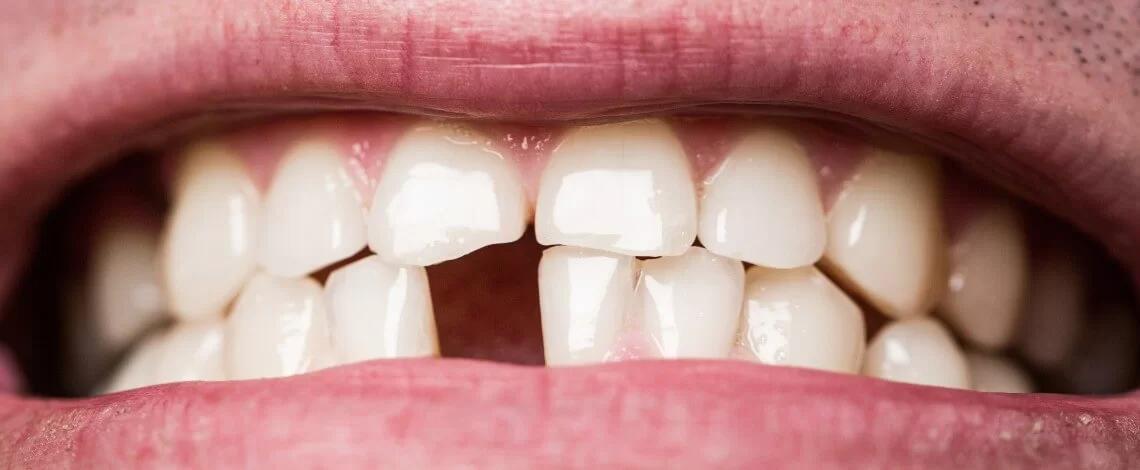 a que edad se caen los dientes en adultos - Por qué se caen los dientes a los 30 años