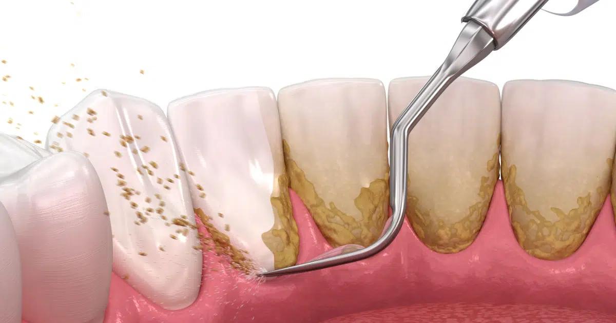placas de dientes - Por qué se forma la placa dental