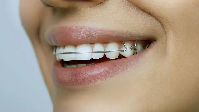 aparato para acomodar los dientes - Qué aparato te ponen para corregir la mordida