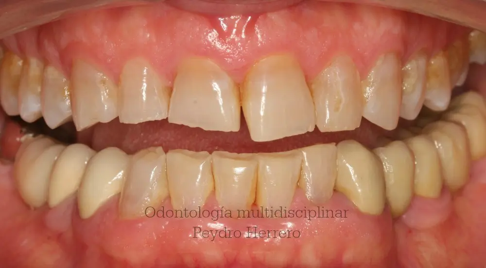 dientes desgastados por bruxismo - Qué consecuencias podría acarrear el desgaste dentario derivado del bruxismo