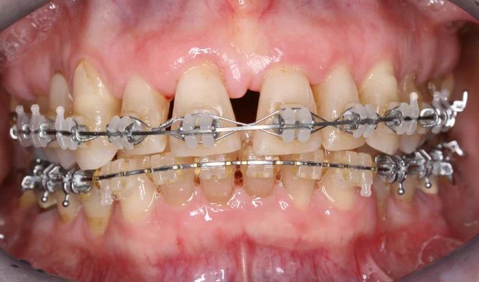 ortodoncia en pacientes periodontales - Qué dentista trata la periodontitis