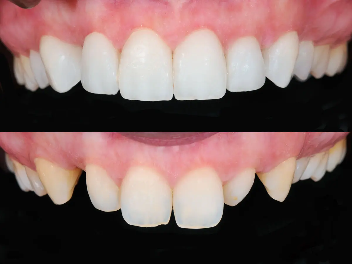 enfundar dientes - Qué diferencia hay entre funda y corona