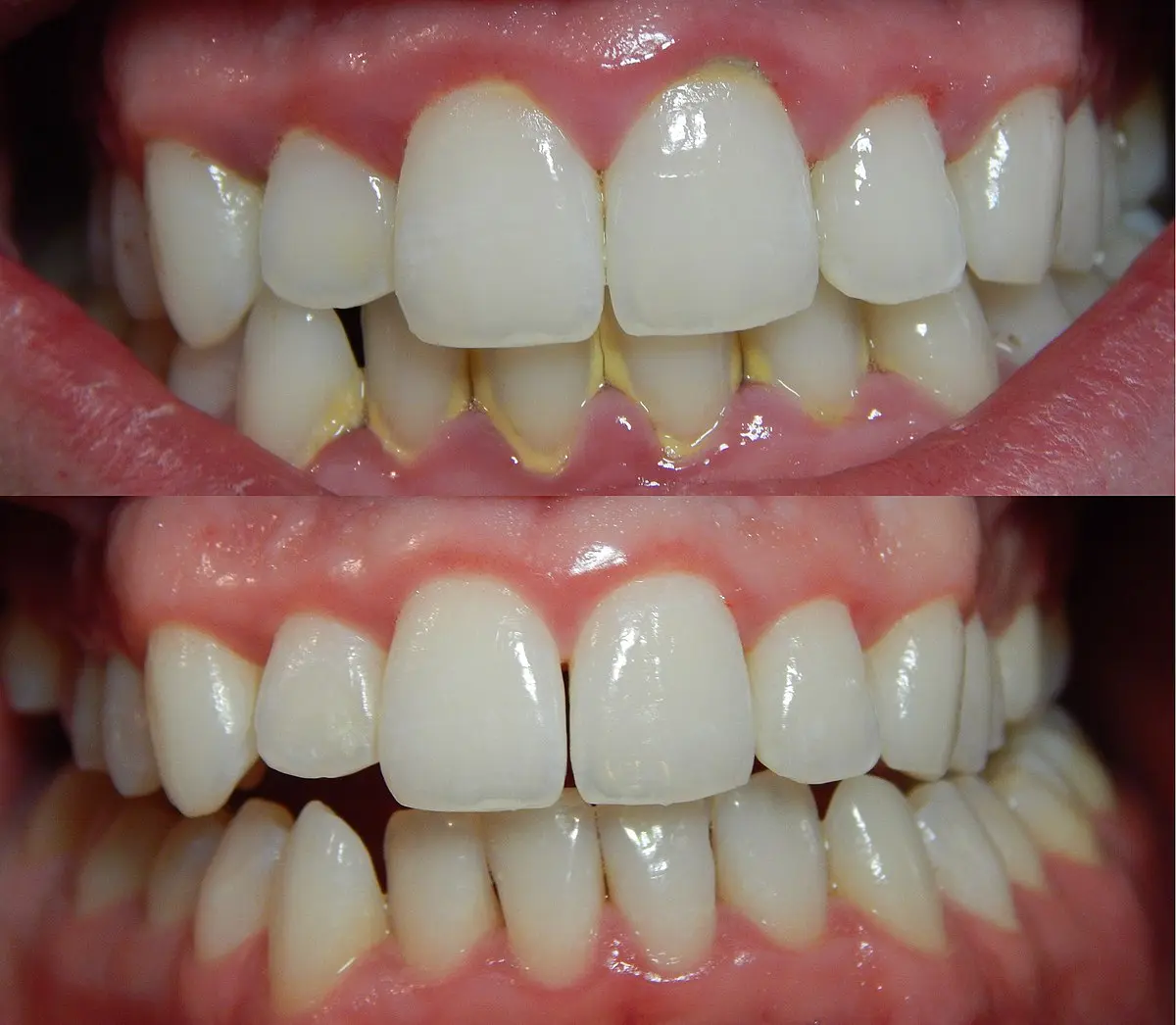 dientes con gingivitis - Qué empeora la gingivitis