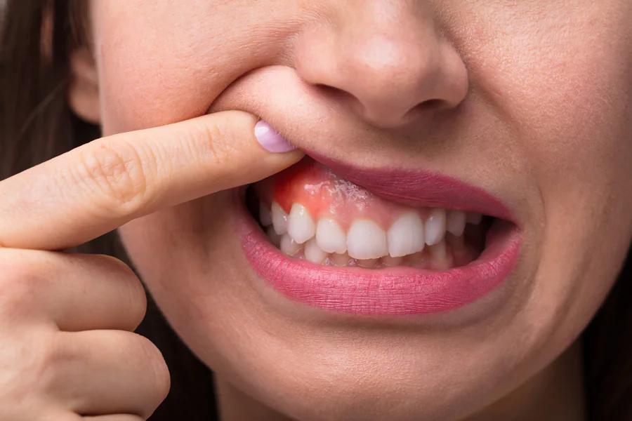 por que duelen los dientes y encias - Qué enfermedad causa dolor en los dientes