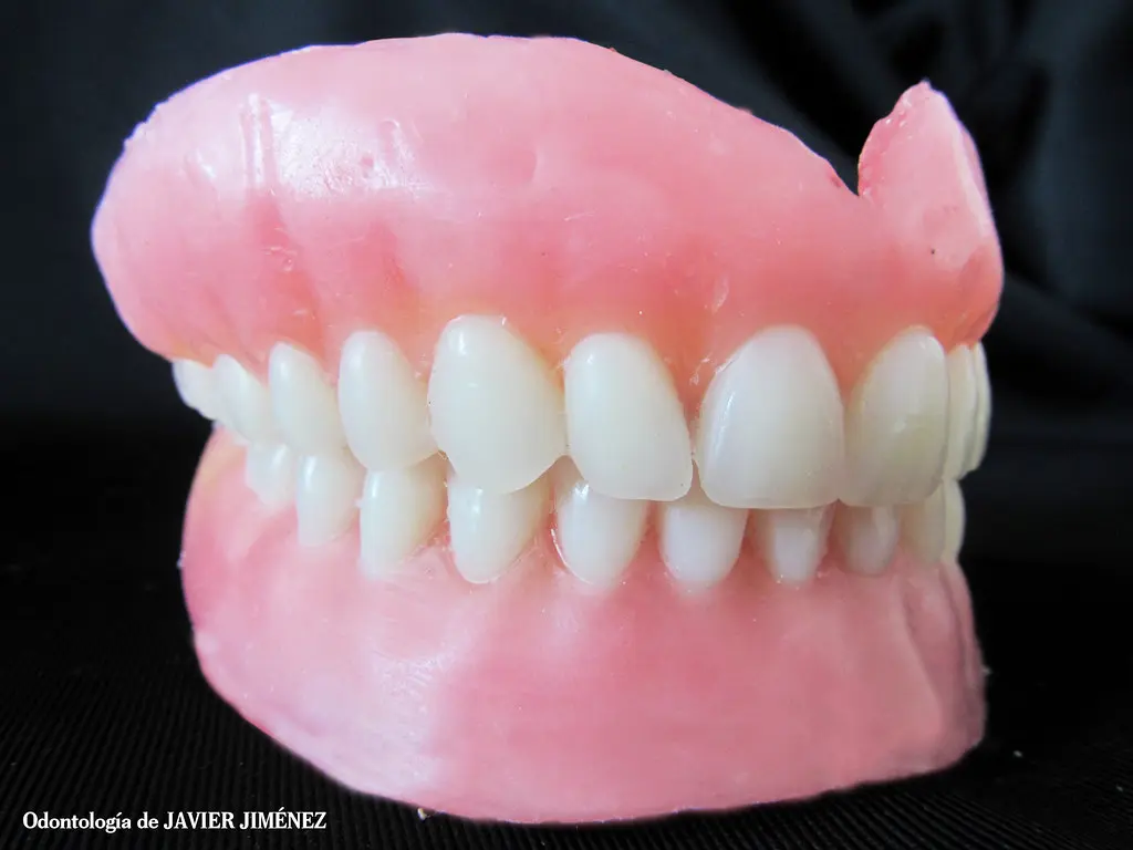 enfilado de dientes - Qué es el Acrilizado dental