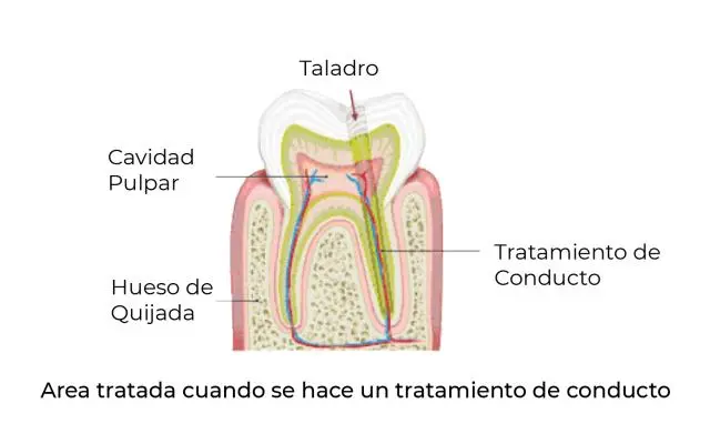 conducto dentista - Qué es el conducto de una muela