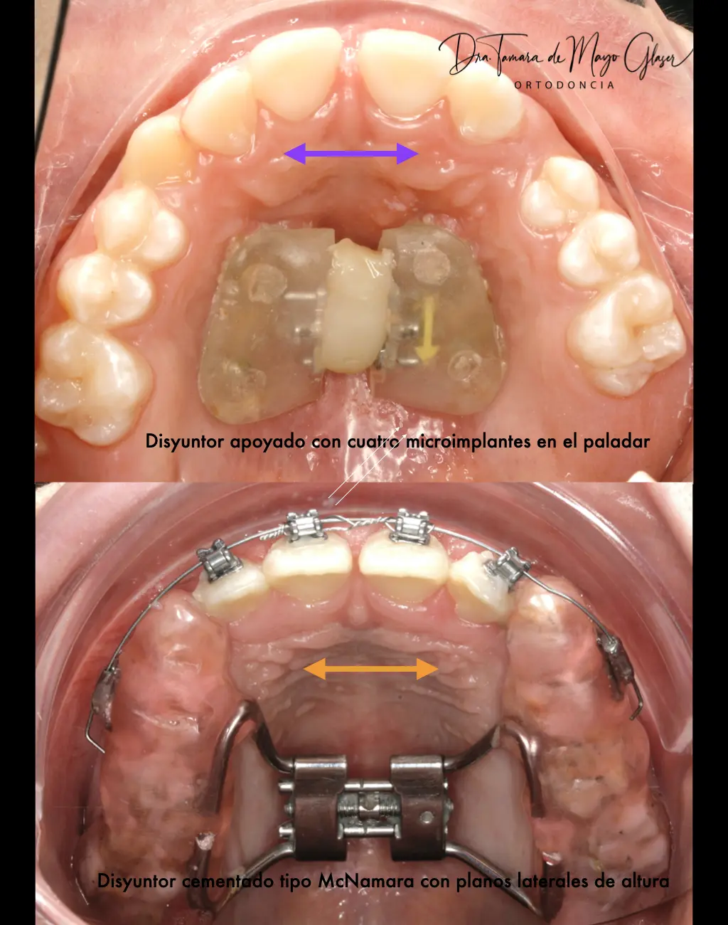 tipos de disyuntores ortodoncia - Qué es el expansor tipo Hass