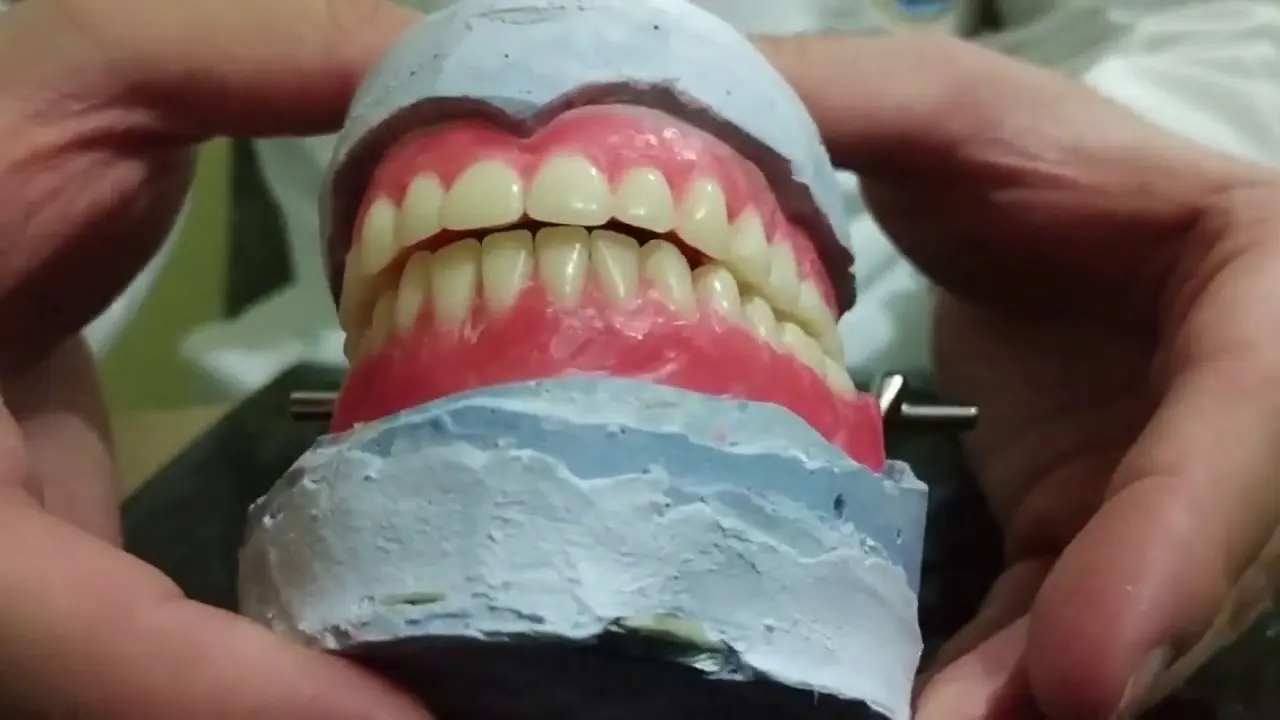 enfilado de dientes - Qué es enfilado en prótesis total
