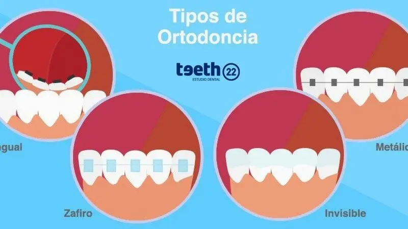 articulos de ortodoncia - Qué es la ortodoncia articulos