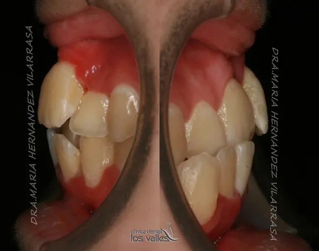 ortodoncia extrema - Qué es la ortodoncia completa