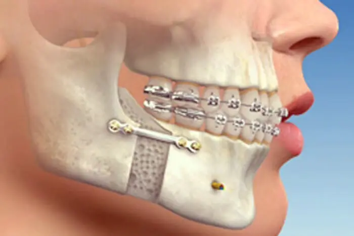 ortodoncia prequirurgica - Qué es la ortodoncia Prequirurgica