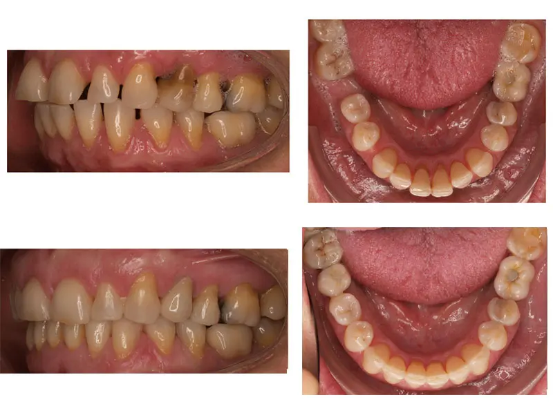 dientes inclinados hacia dentro - Qué es la protrusión mandibular