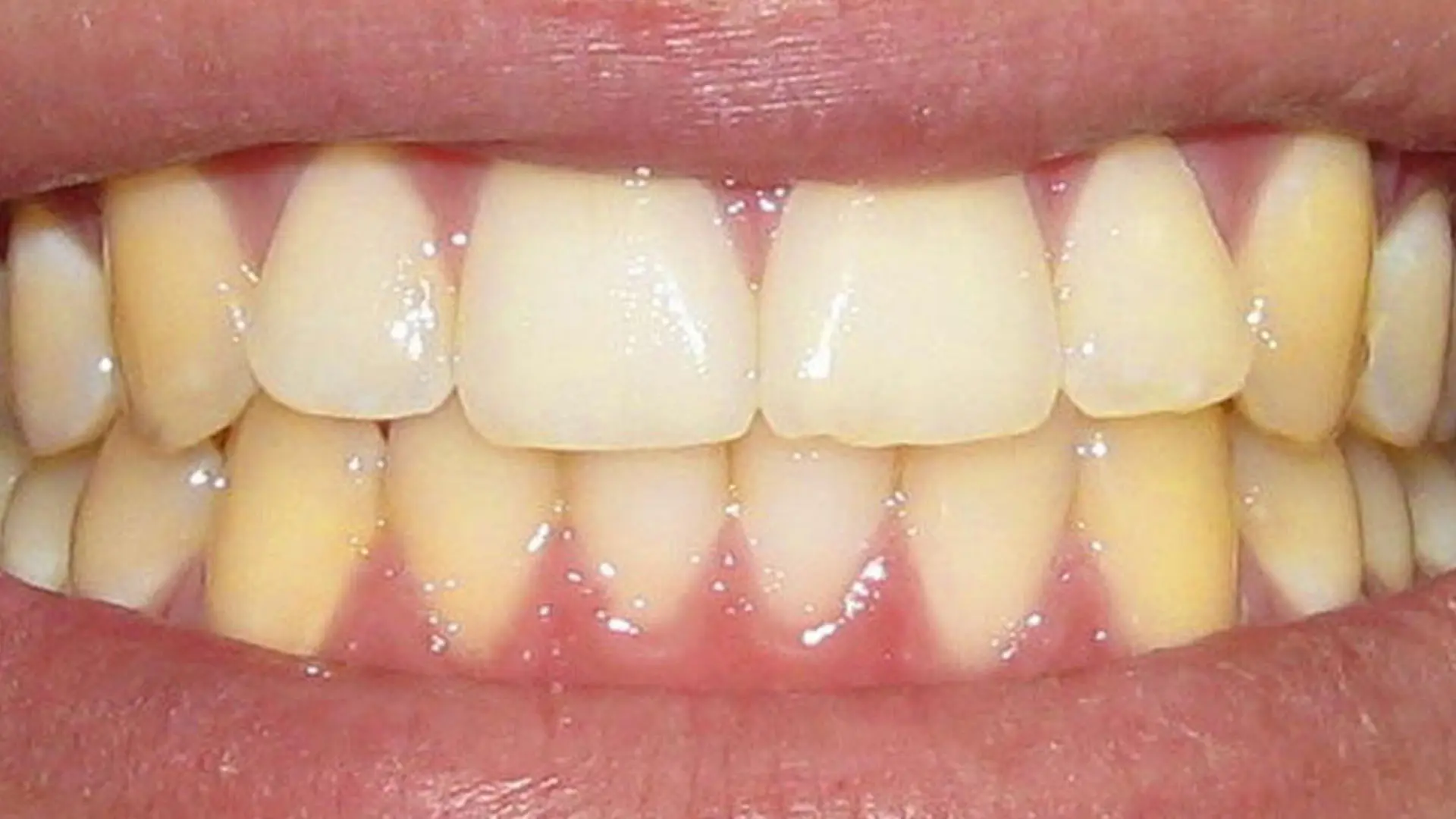 dientes amarillos es normal - Qué es más saludable los dientes amarillos o blancos