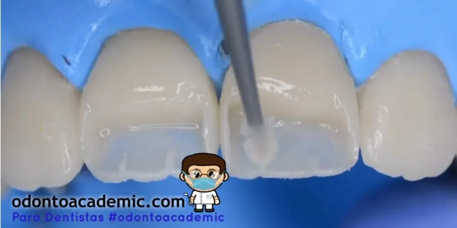 reconstruccion de diente con resina - Qué es reconstrucción de resina
