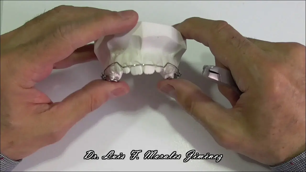 arco utilitario ortodoncia - Qué es un arco utilitario en ortodoncia