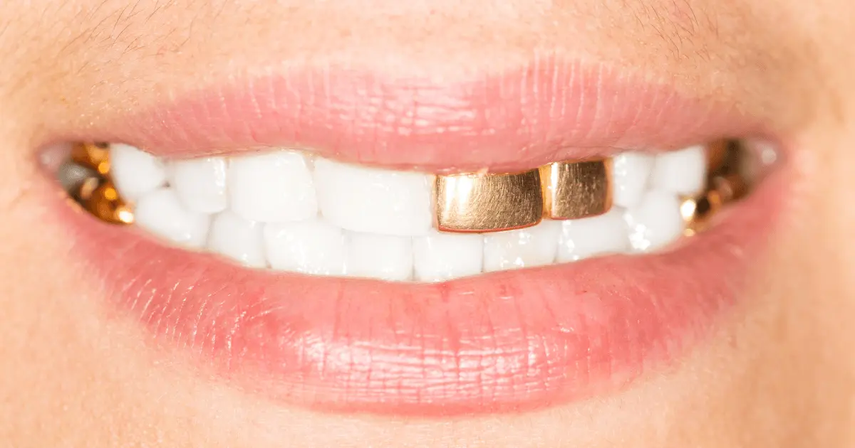 diente de oro - Qué es un diente de oro