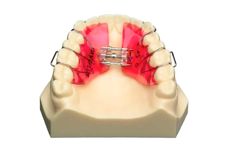placas schwartz ortodoncia - Qué es un Holy dental
