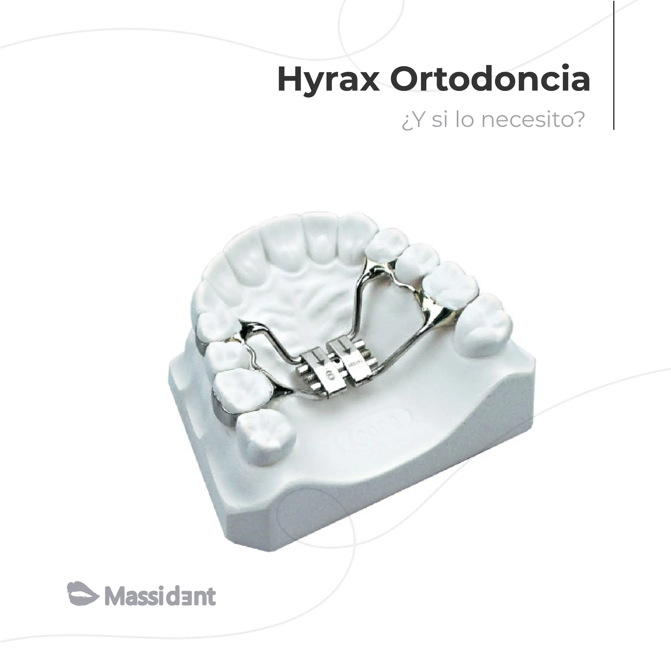 Expansión rápida del maxilar superior con hyrax ortodoncia