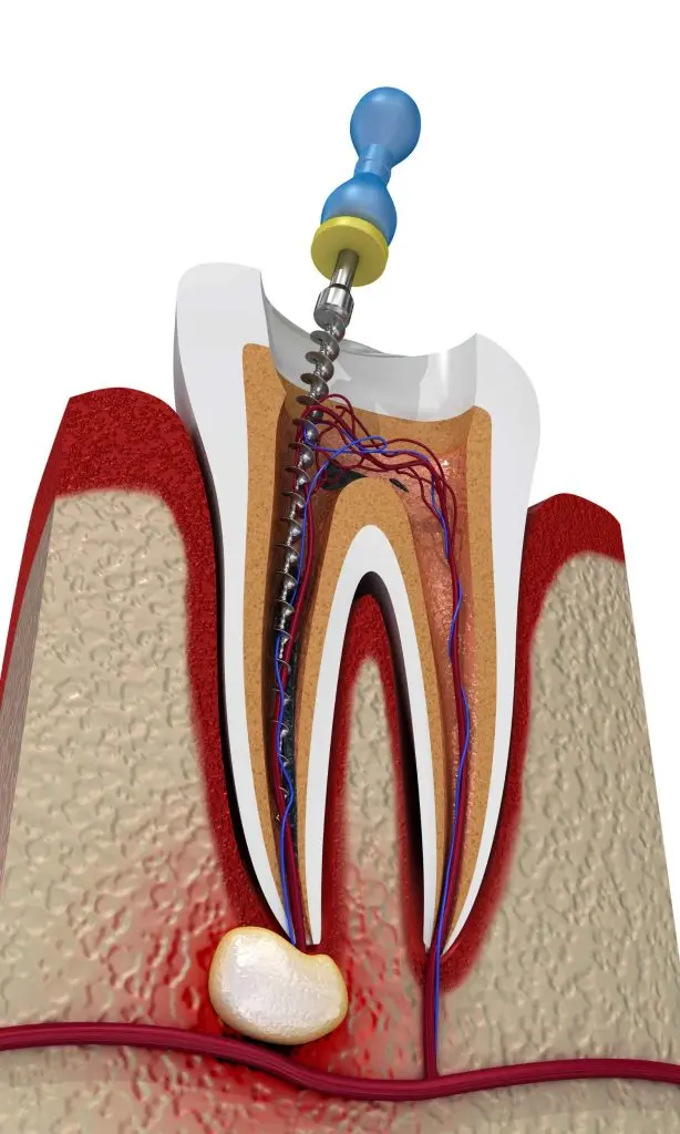 dentista tratamiento de conducto - Qué es un tratamiento de conductos dentales