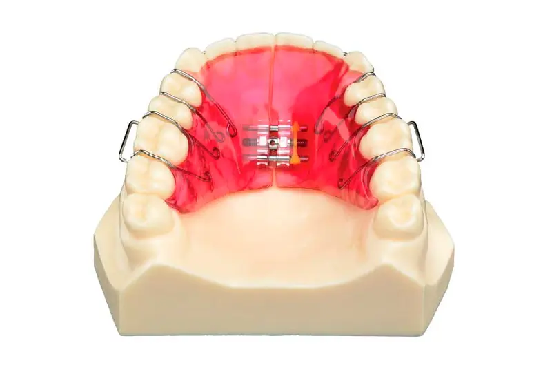 placa activa ortodoncia - Qué es una placa pasiva