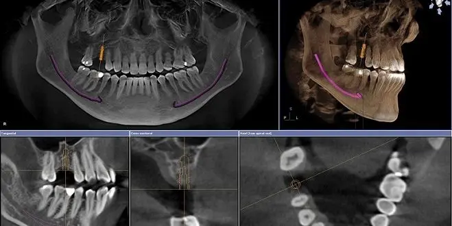 tomografia de dientes - Qué es una tomografía de los dientes