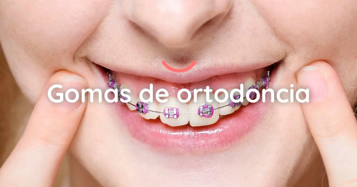 gomas clase 2 ortodoncia - Qué hacen las gomas en la ortodoncia