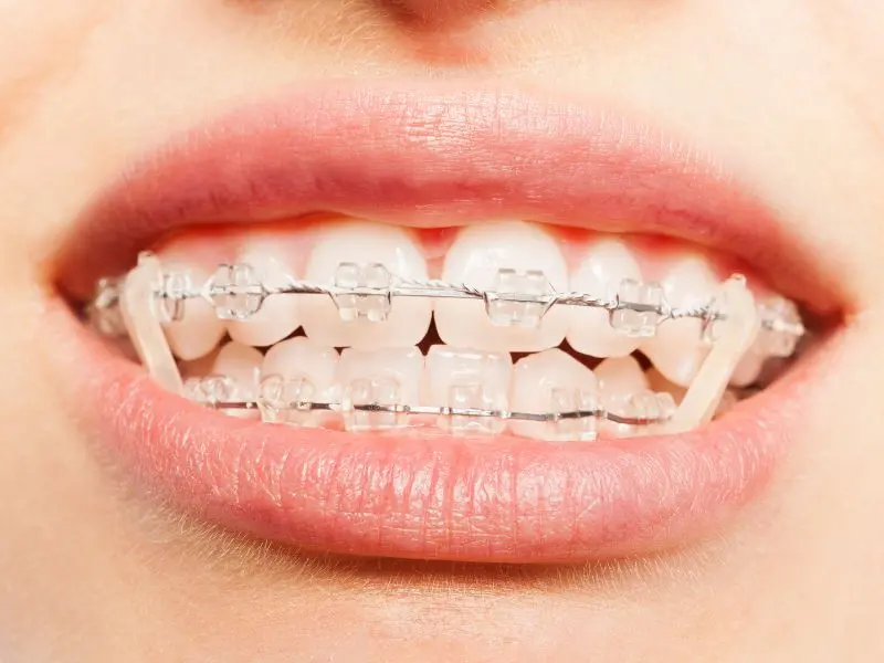 gomas dientes - Qué hacen los elásticos en los dientes