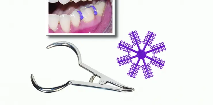 separadores de dientes - Qué hacen los separadores en los dientes