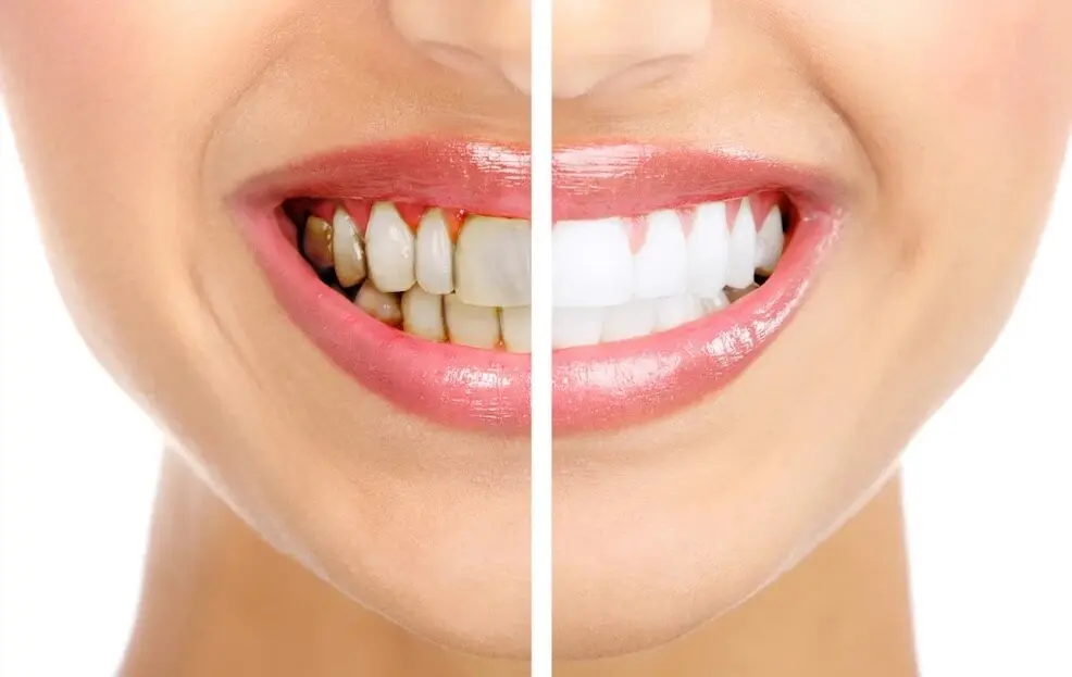 como eliminar las manchas de los dientes - Qué hacer con las manchas en los dientes