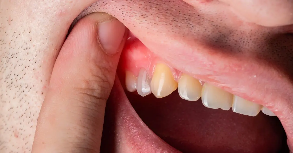 encia hinchada en un diente - Qué hacer cuando la encía está hinchada