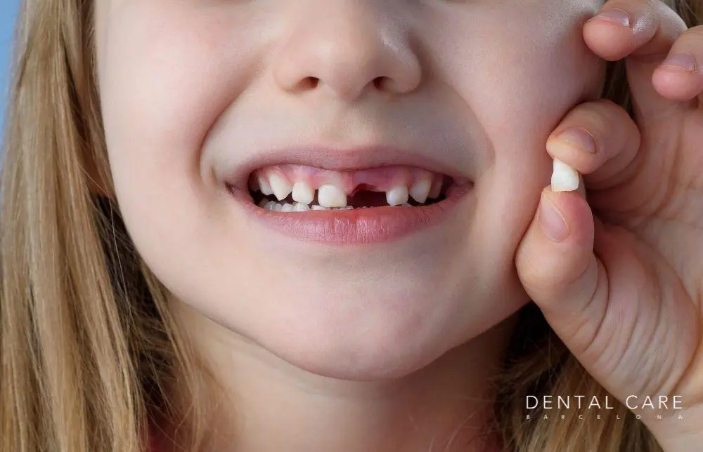 extraccion de dientes de leche en niños - Qué hacer después de sacar un diente de leche