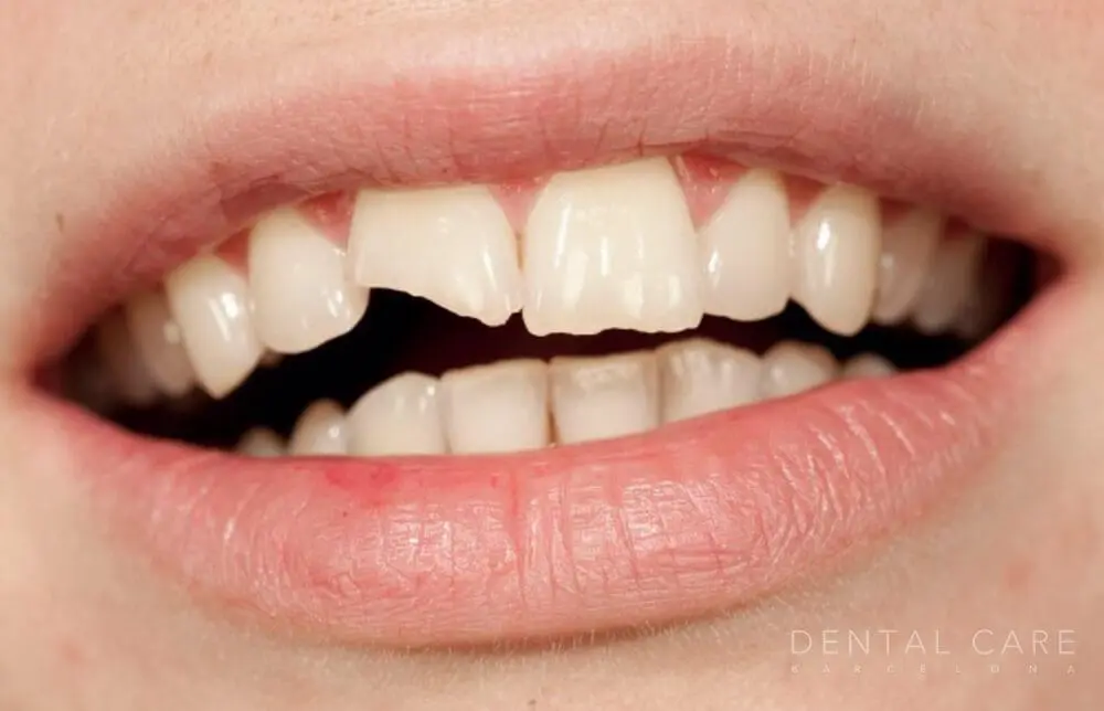 rotura de diente - Qué hacer en caso de que se rompa un diente